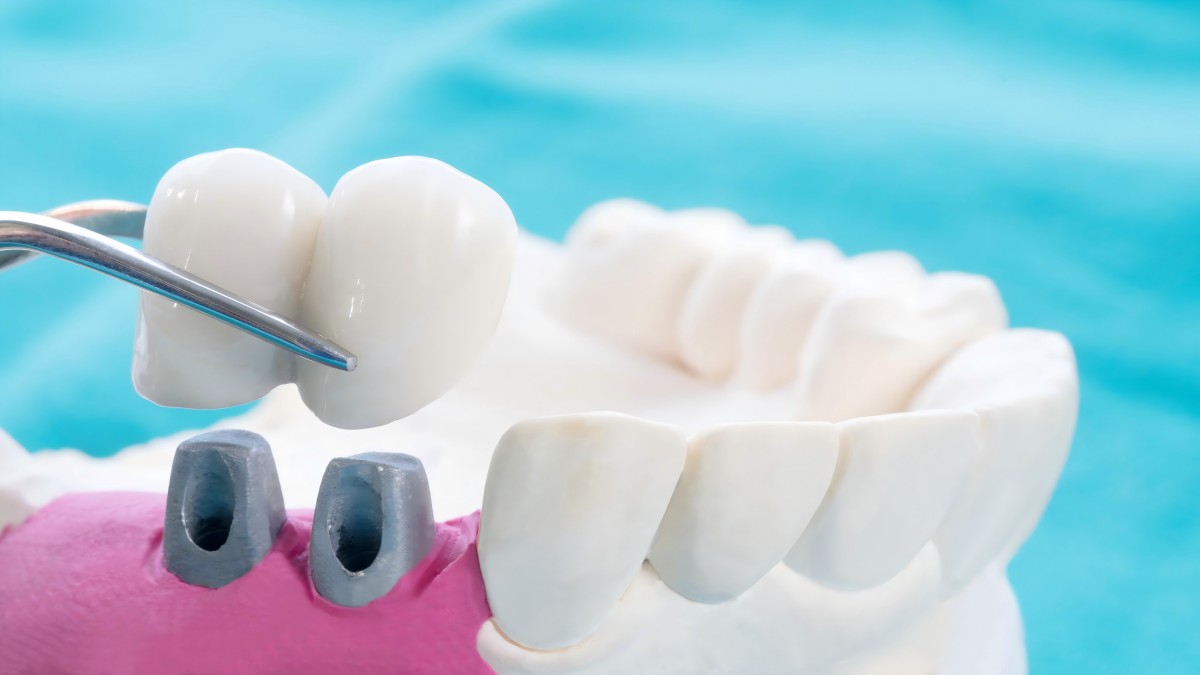 The Latest Advances in Dental Implants: What You Need to Know