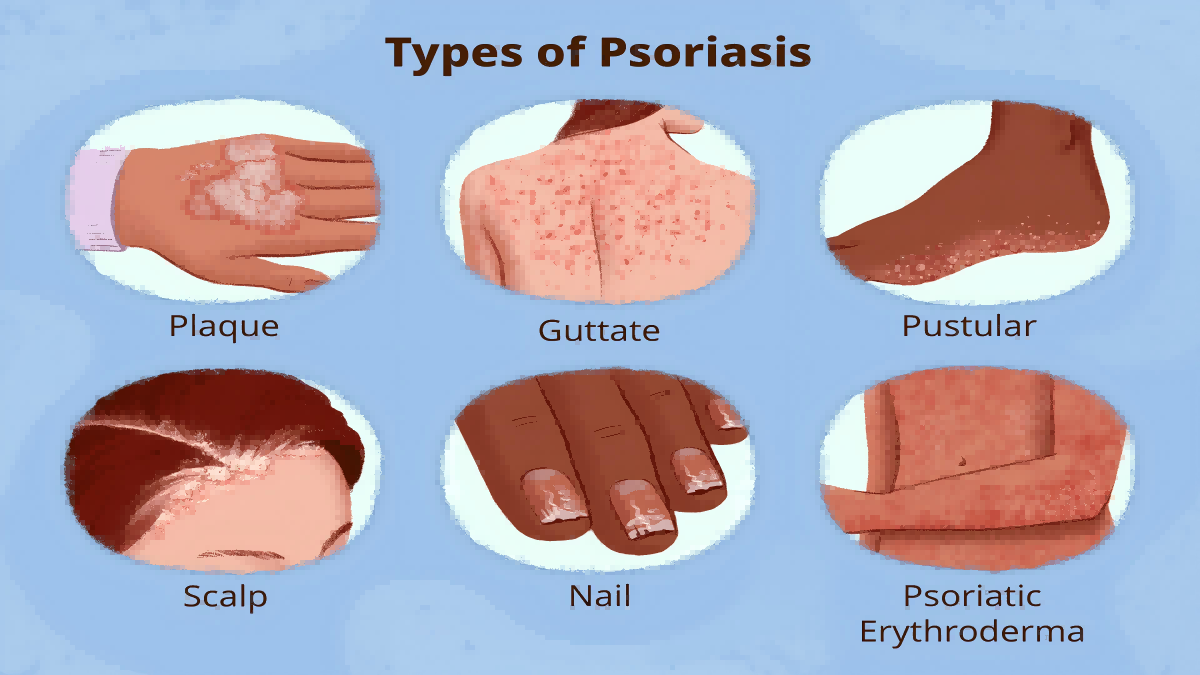 Understanding the symptoms and treatment of plaque psoriasis