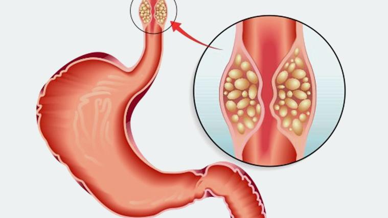 Esophageal Cancer Symptoms, Risk Factors, and Treatment Options